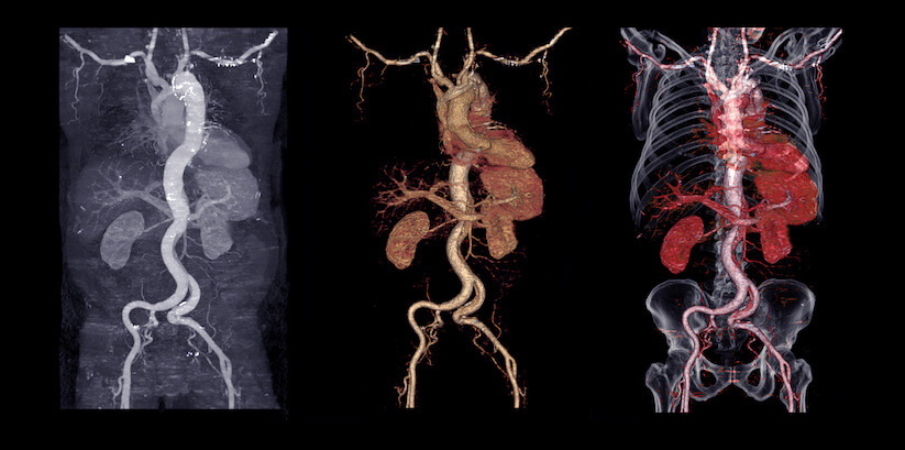 Comparison of CTA abdominal aorta 3D rendering image